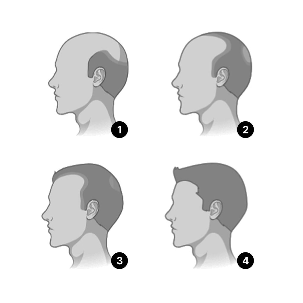 Hair regrowth progress